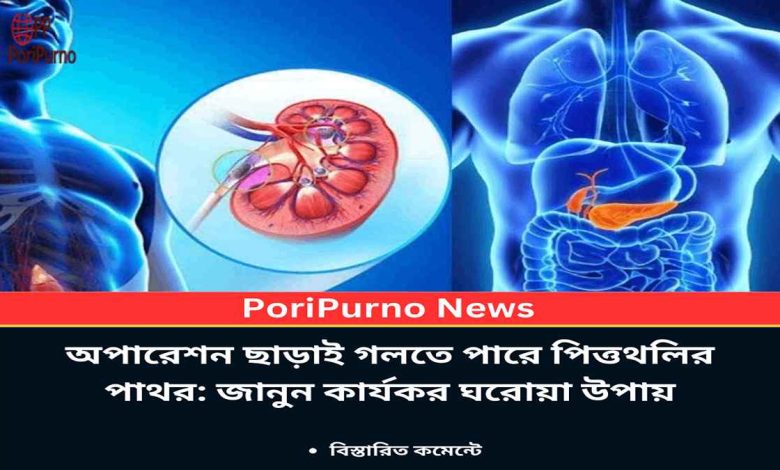 dissolve gallstones without surgery